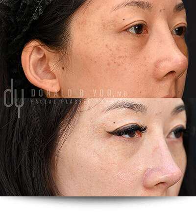Before and After 3-quarter view of PicoSure Pro treatment