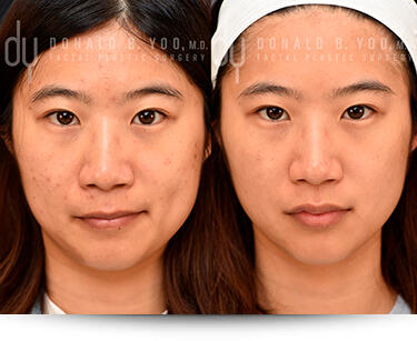 PicoSure Pro before and after