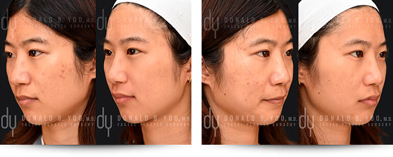 before and after PicoSure Pro