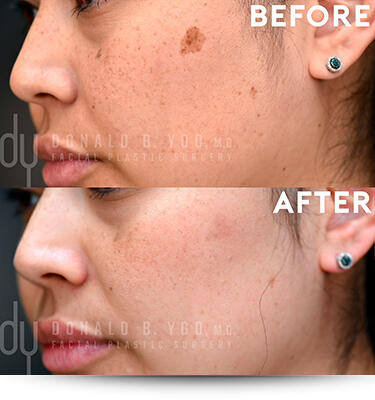 Before and After photo of PicoSure Pro treatment