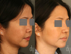 Before and After augmentation Asian rhinoplasty with DCF (diced cartilage fascia) and rib cartilage harvest.  