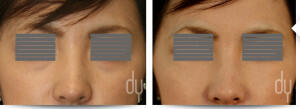 Before and after lower blepharoplasty with fat repositioning.  