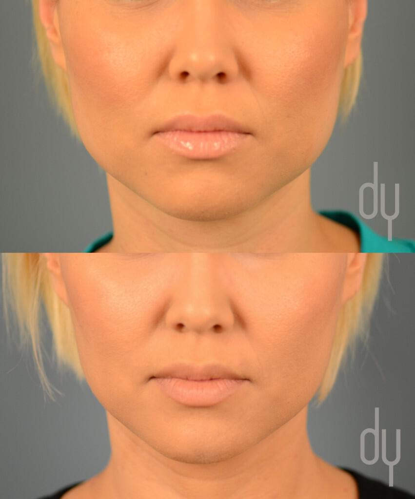 Botox for masseter reduction (jaw reduction) performed to taper and slim the face.   
