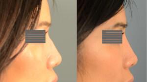 Before + After non-surgical rhinoplasty for softening and straightening profile.