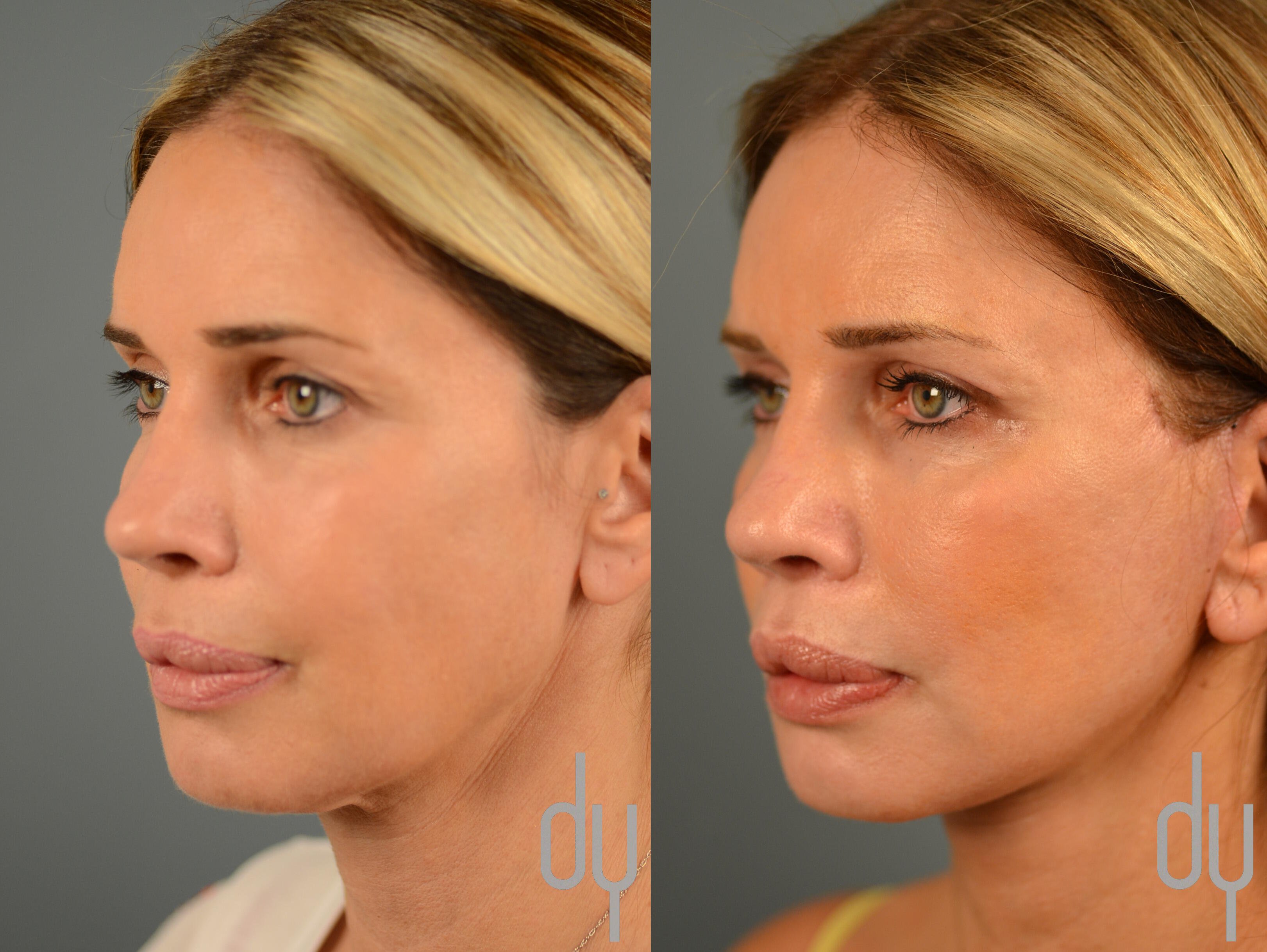 Deep Plane Facelift: la evolución del lifting - Clínica HB