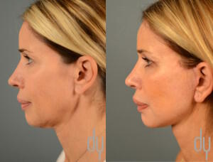 Before and After Deep Plane Facelift Surgery (Rhytidectomy)