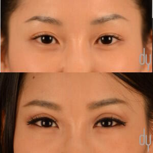 Before and After Asian Eyelid Surgery | Asian Blepharoplasty