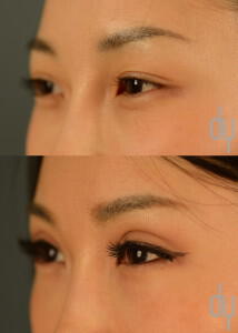 Before and After Asian Eyelid Surgery | Asian Blepharoplasty