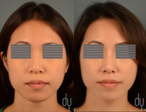 Before and After Asian Rhinoplasty with DCF (diced cartilage fascia)