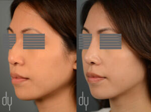 Before and After Asian Rhinoplasty with DCF (diced cartilage fascia)