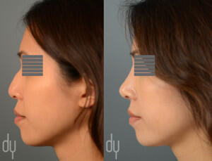 Before and After Asian Rhinoplasty with DCF (diced cartilage fascia)