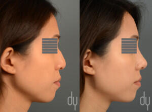 Before and After Asian Rhinoplasty with DCF (diced cartilage fascia) and ear cartilage graft.