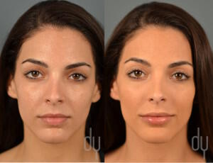 Before and After lip augmentation with Restylane®, Restylane Silk®, Juvederm Ultra®.