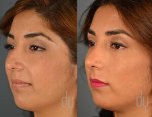 Before and After rhinoplasty | nose job with septoplasty, tip refinement, and dorsal hump reduction. 