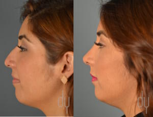 Before and After rhinoplasty | nose job with septoplasty, tip refinement, and dorsal hump reduction. 