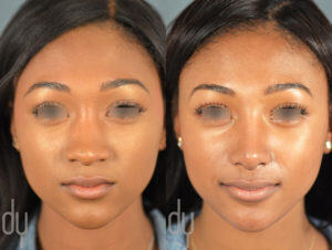 African America Rhinoplasty Frontal View