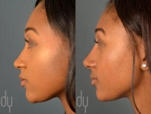 African American Female Rhinoplasty - Left Profile View 