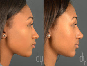 African American Female Rhinoplasty - Right Profile View