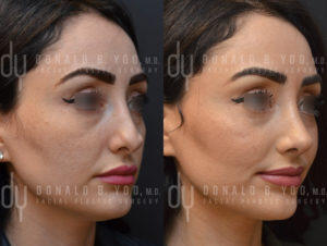 Revision Rhinoplasty Right 3qt View