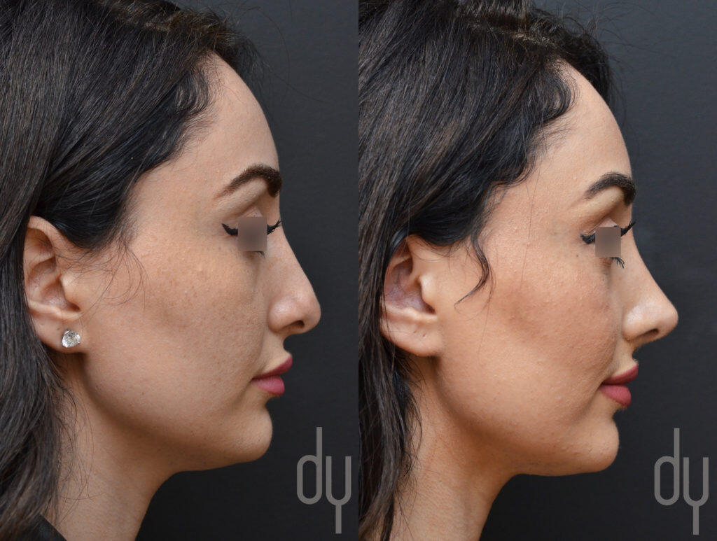 Open Revision Rhinoplasty Before And After Beverly Hills Facial