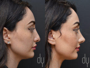 Revision Rhinoplasty Right Profile View