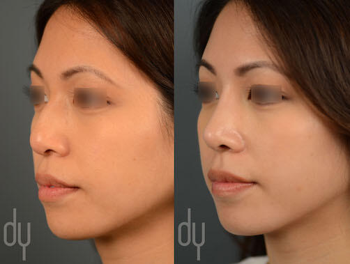 Gallery | Beverly Hills Facial Plastic Surgery - Donald B. Yoo M.D.