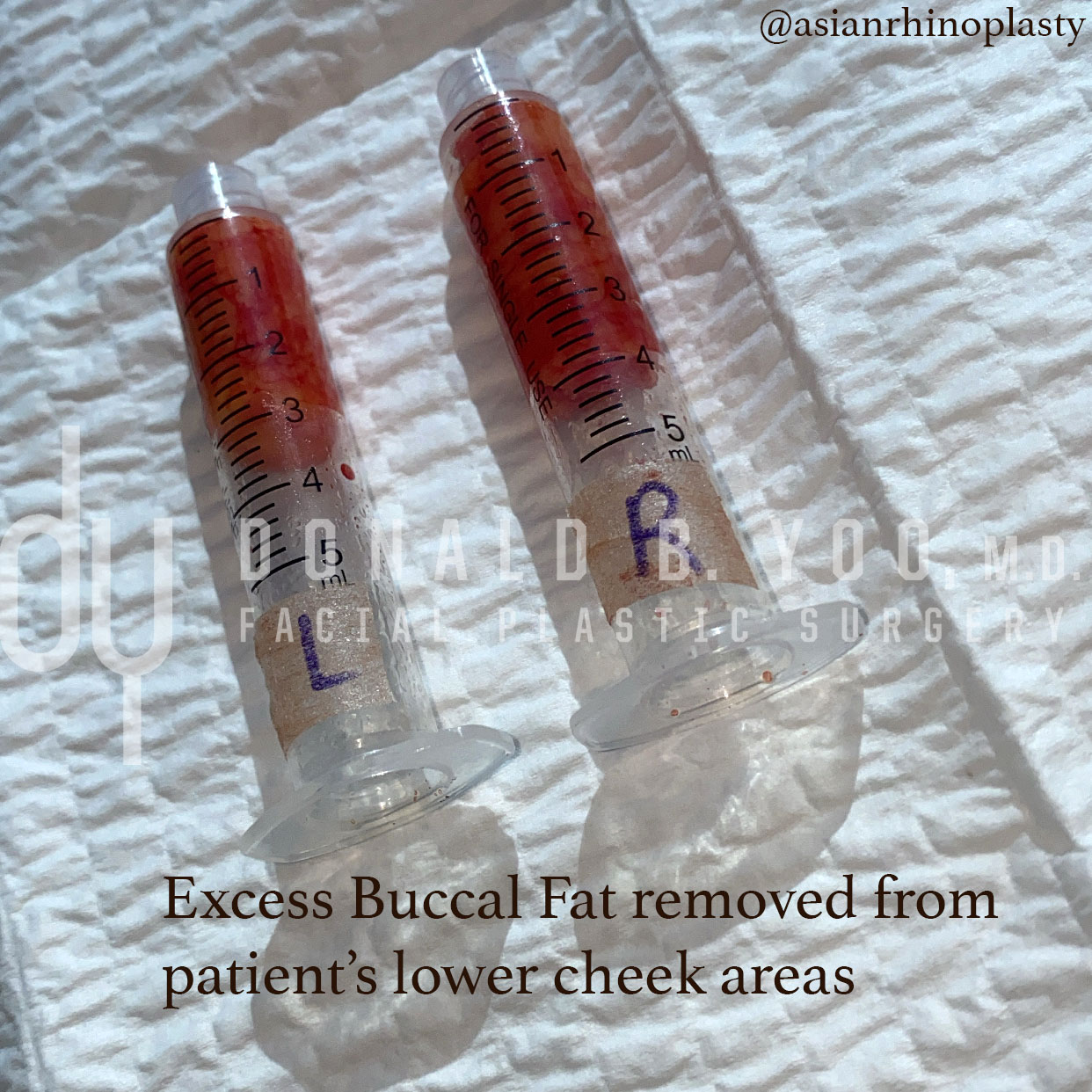 SURGICAL :: BUCCAL FAT REMOVAL<br>Buccal fat removal 