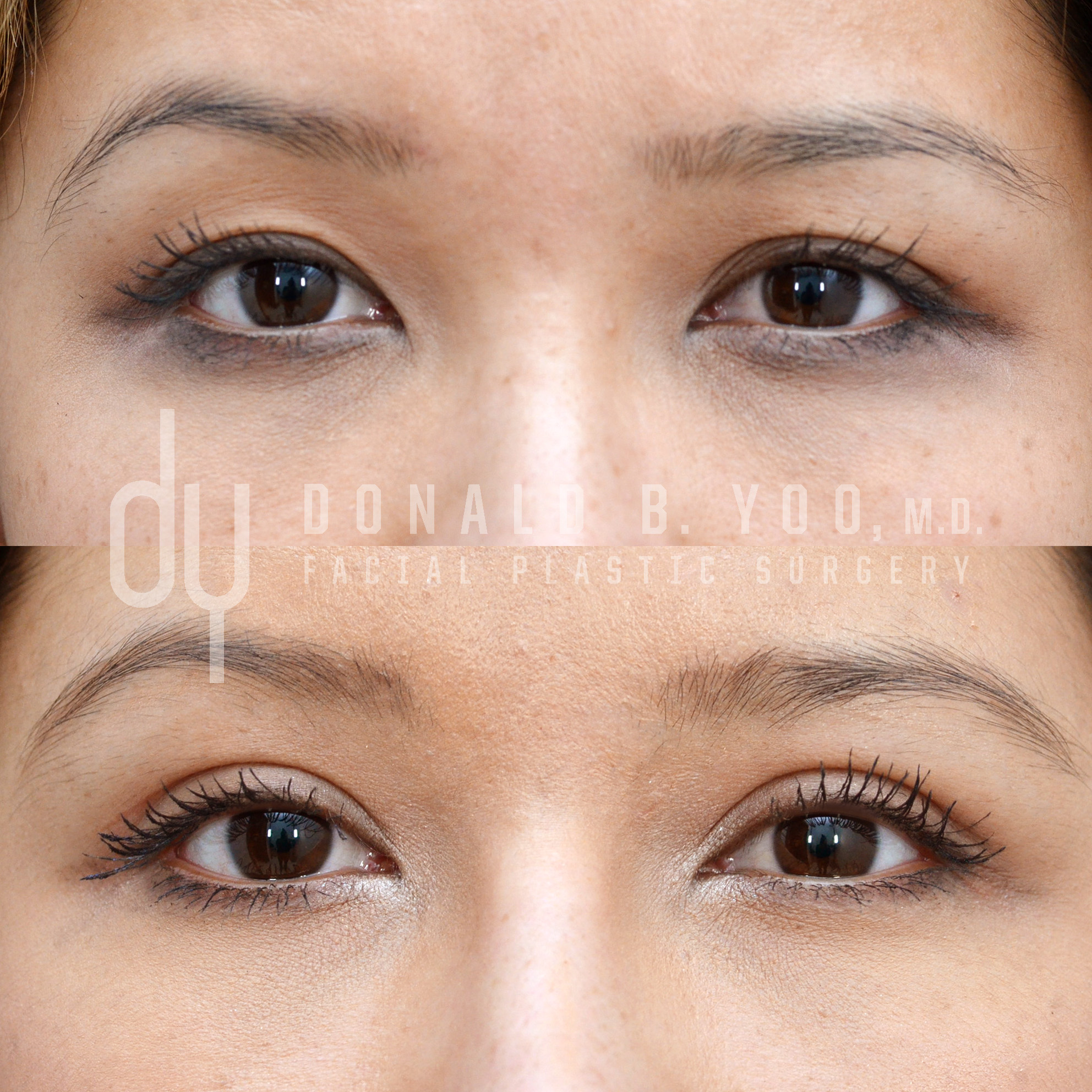 Beverly Hills Facial Plastic Surgery – Donald B. Yoo M.D. - Services:  Surgical Fat Pad Removal