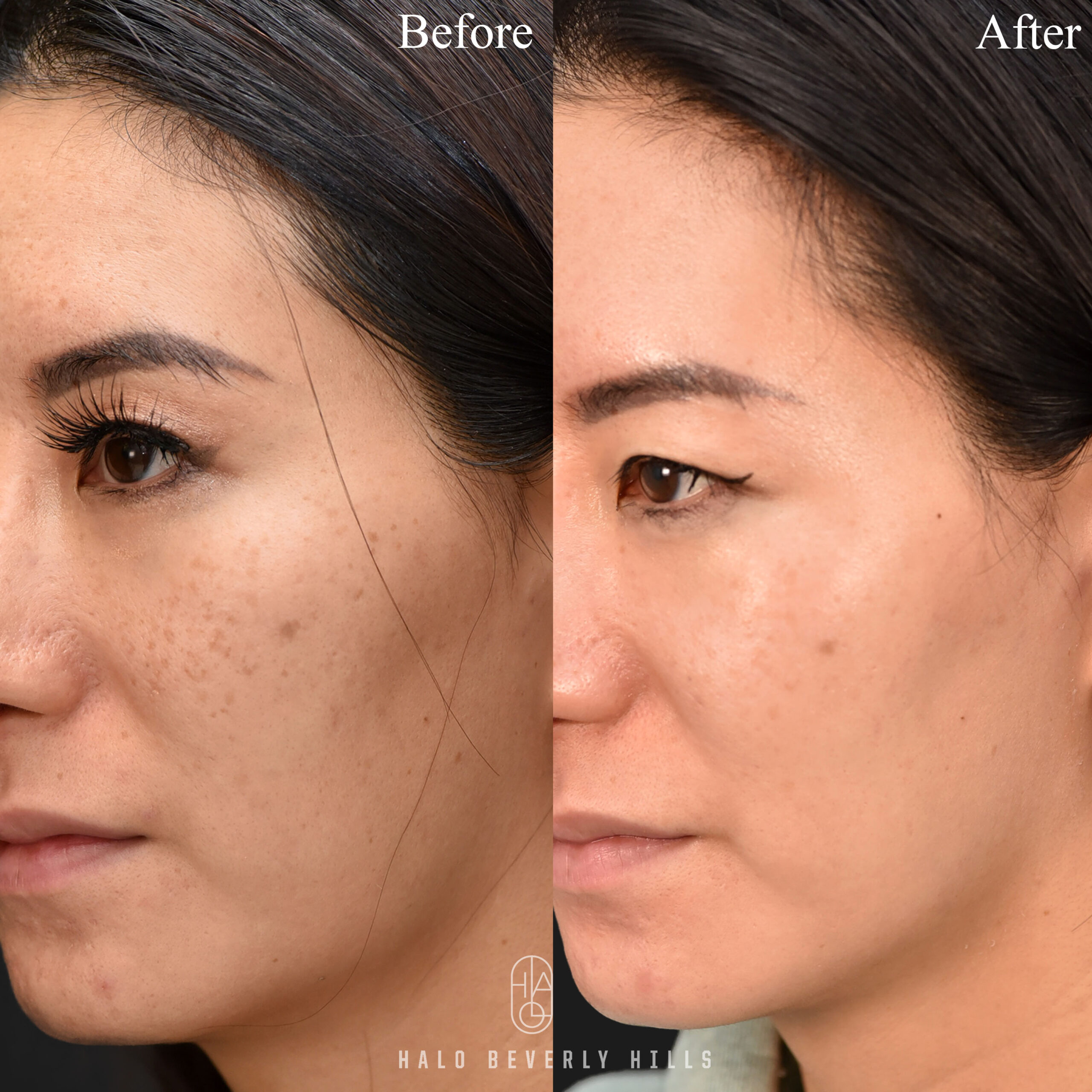 Beverly Hills Facial Plastic Surgery – Donald B. Yoo M.D. - Services:  Surgical Fat Pad Removal