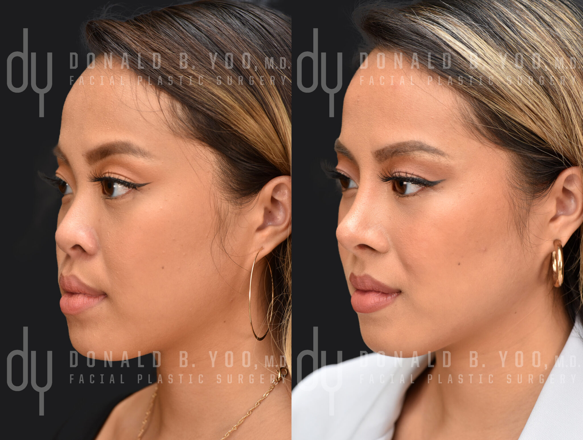 How Long Does Asian Rhinoplasty Last Beverly Hills Facial Plastic Surgery Donald B Yoo Md 2495