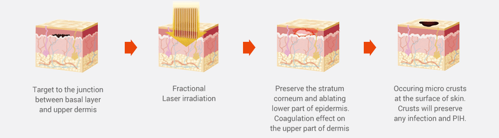 Mechanism of Action of BB Laser 