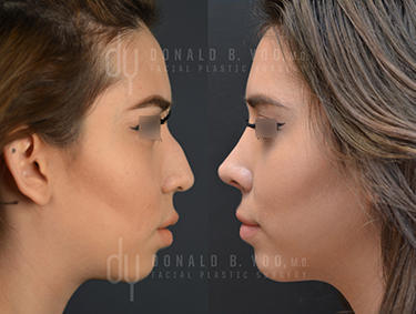 Before and After Photo of Rhinoplasty Procedure