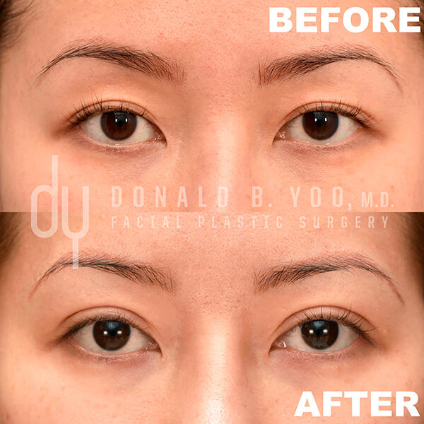 Before and after photo of Asian Blepharoplasty results