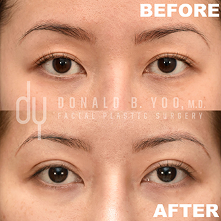 asian blepharoplasty before and after