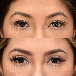asian blepharoplasty outfold crease