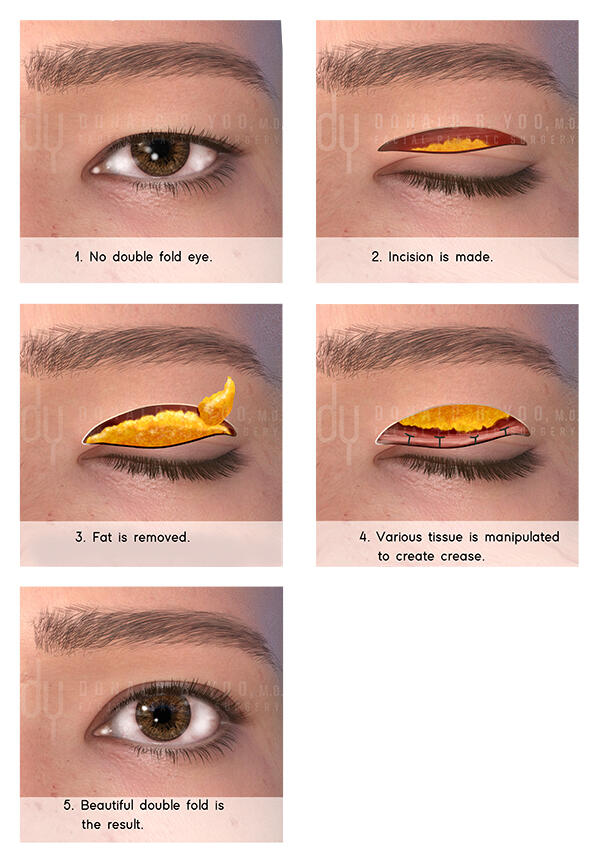 Asian Blepharoplasty