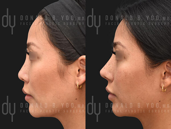 Asian Rhinoplasty Photo - Before and After - Left Profile View