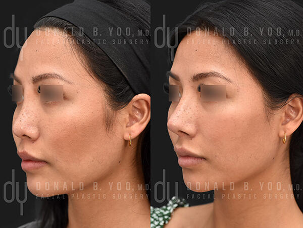 Asian Rhinoplasty Photo - Before and After 3 quarter view