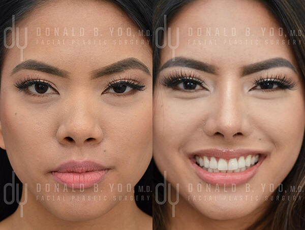 Asian Rhinoplasty Photo - Before and After Front View closeup