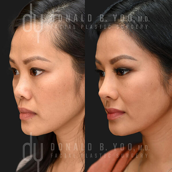 Asian Rhinoplasty Before and After 3 quarter view