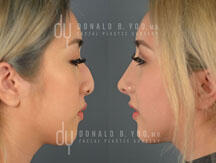 Before and After Asian Rhinoplasty