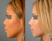 surgical Asian rhinoplasty with rib cartilage and diced cartilage fascia