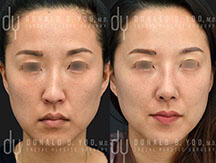 Asian nose job Before and After