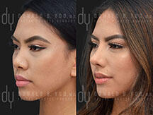 Asian Rhinoplasty Frontal Before and After