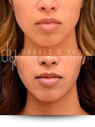 Botox for masseter reduction before and after