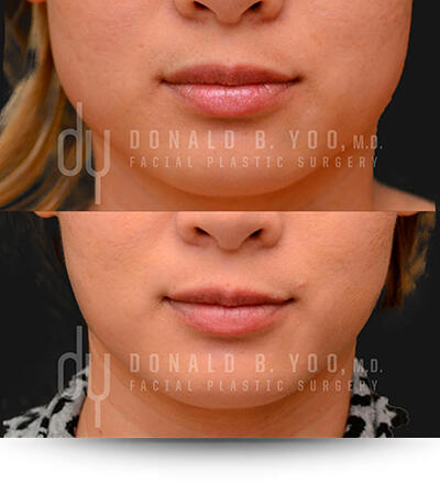 Before and after of Botox for masseter reduction