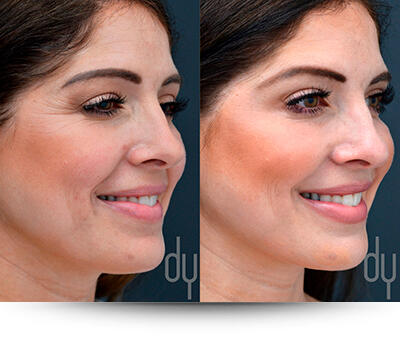 Botox/Dysport before and after