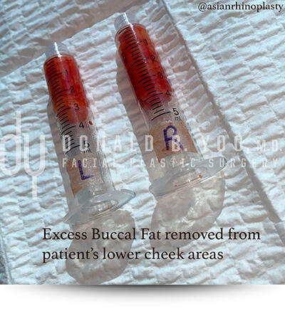 Excess Buccal Fat removed from patients lower cheek areas