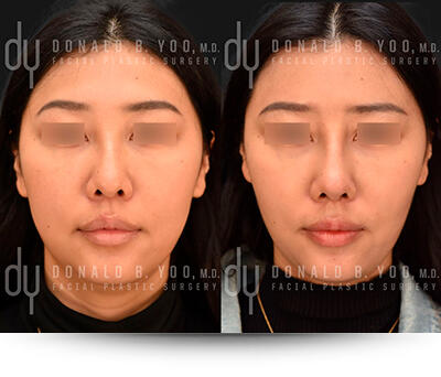 Buccal Fat Pad Removal patient photo