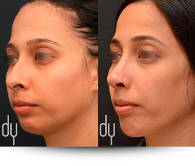 Before and after of Chin Augmentation